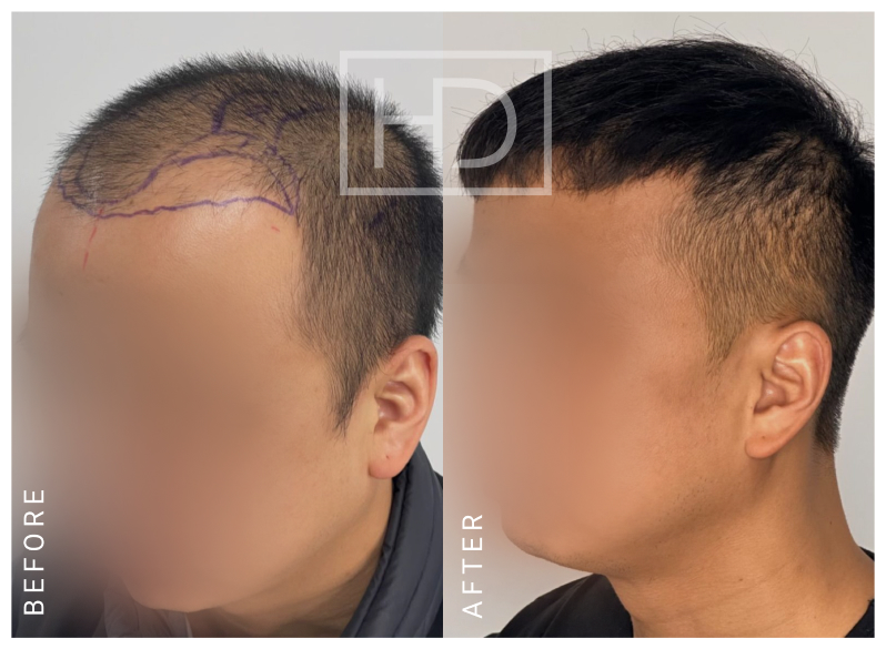 Doctor Hair Transplant