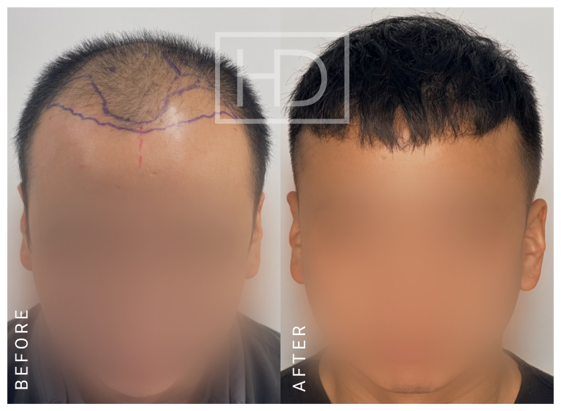 Doctor Hair Transplant