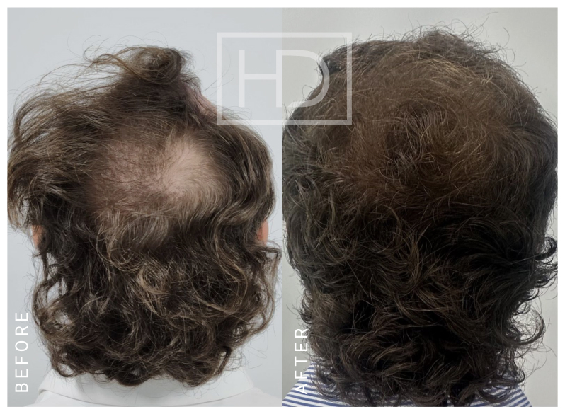 Doctor Hair Transplant