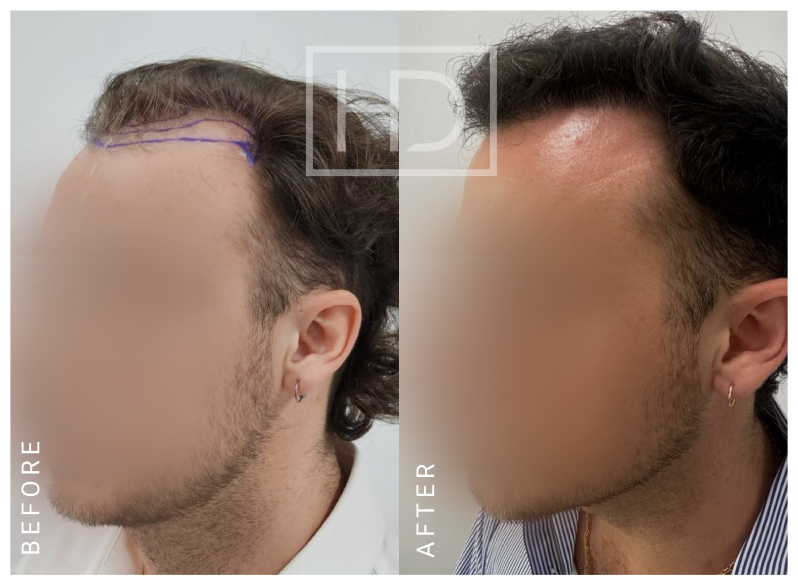 Doctor Hair Transplant