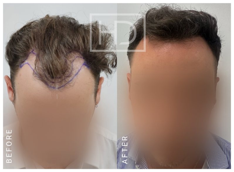 Doctor Hair Transplant