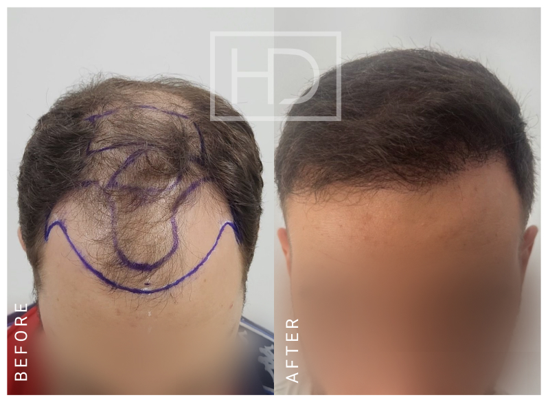 Doctor Hair Transplant