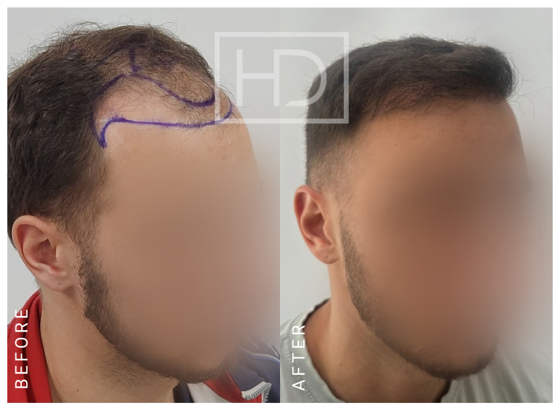 Doctor Hair Transplant