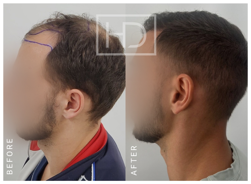 Doctor Hair Transplant