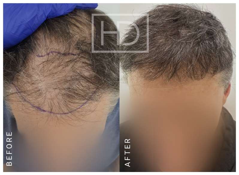 Doctor Hair Transplant