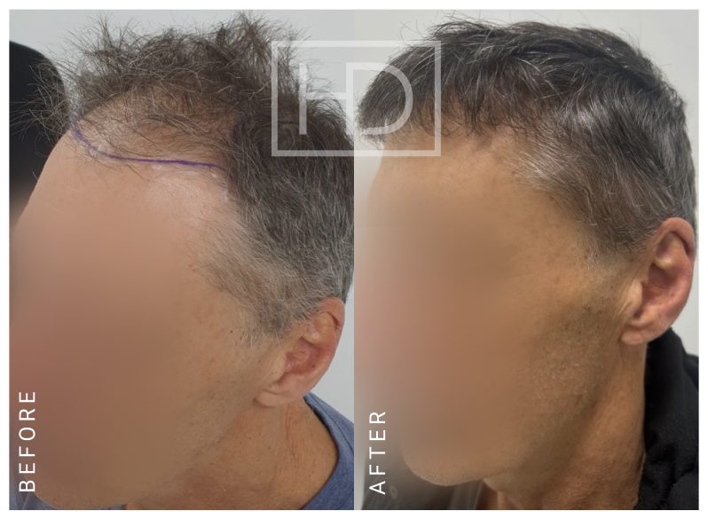 Doctor Hair Transplant