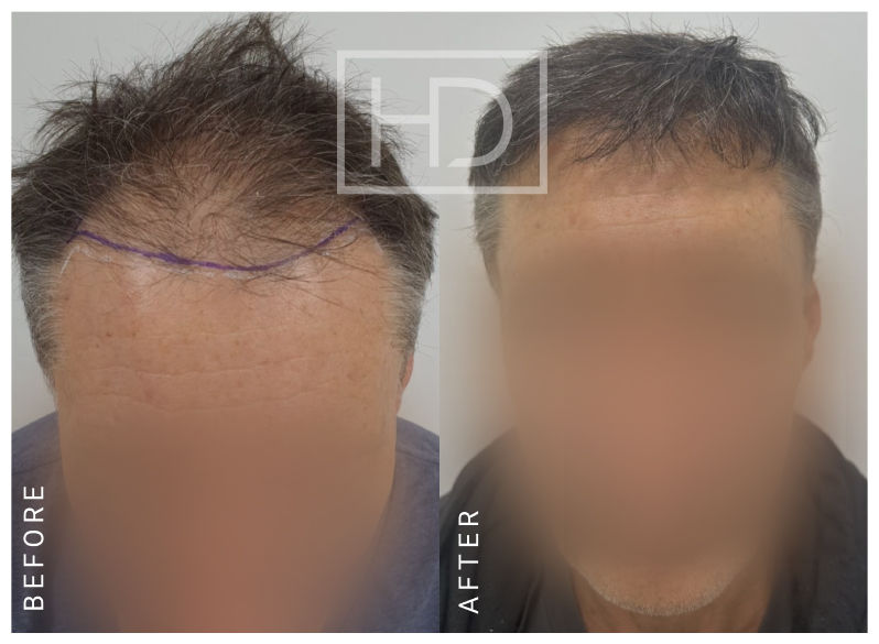 Doctor Hair Transplant