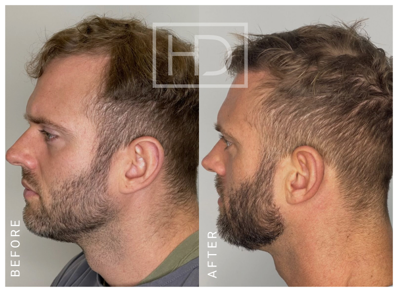 Doctor Hair Transplant
