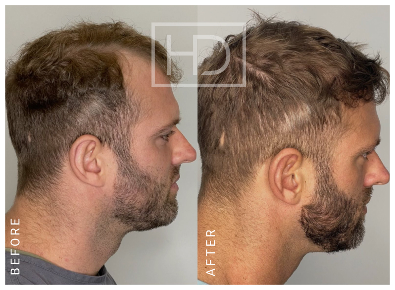 Doctor Hair Transplant