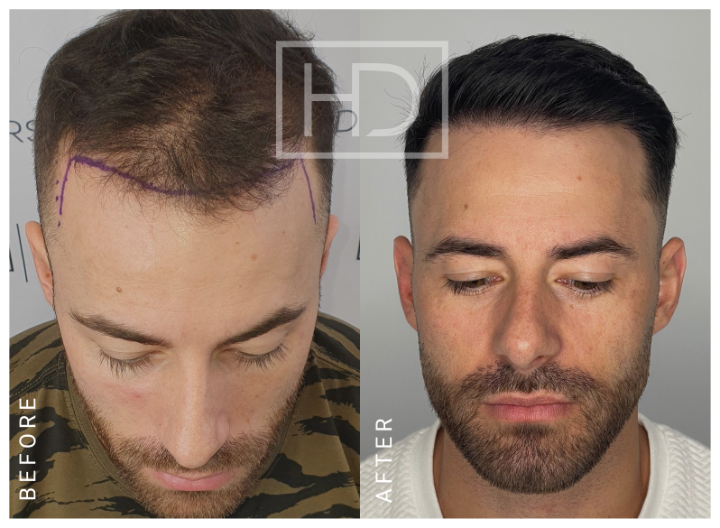 Doctor Hair Transplant
