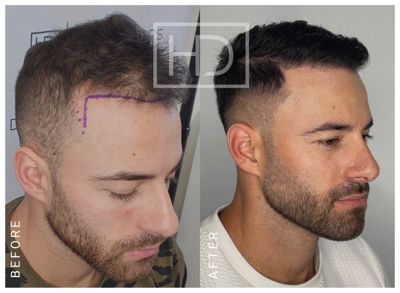 Doctor Hair Transplant