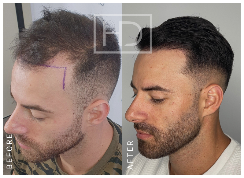 Doctor Hair Transplant Before & After