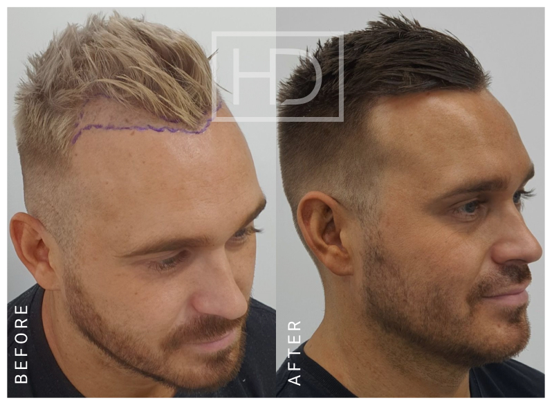 Doctor Hair Transplant Before & After