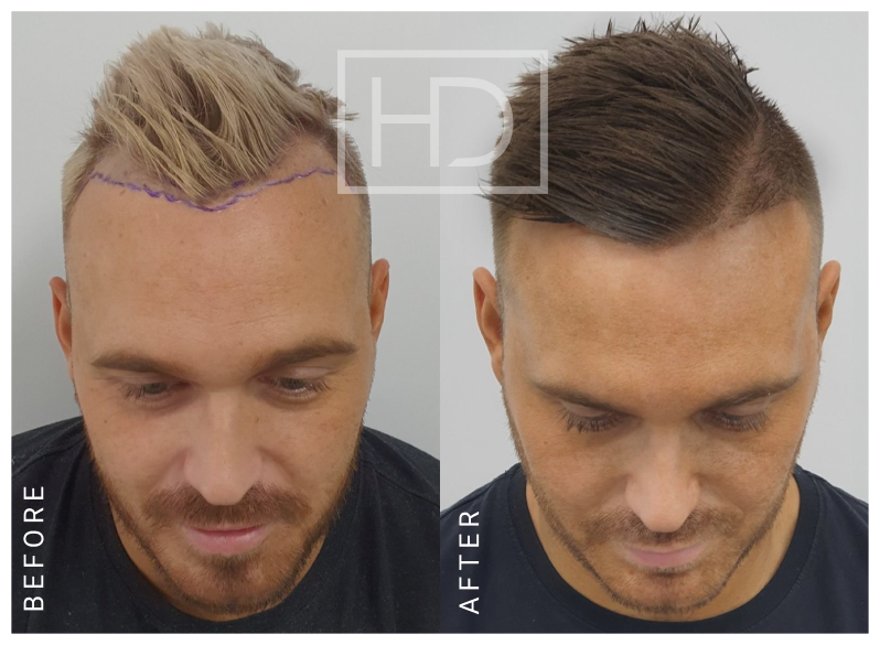 Doctor Hair Transplant Before & After