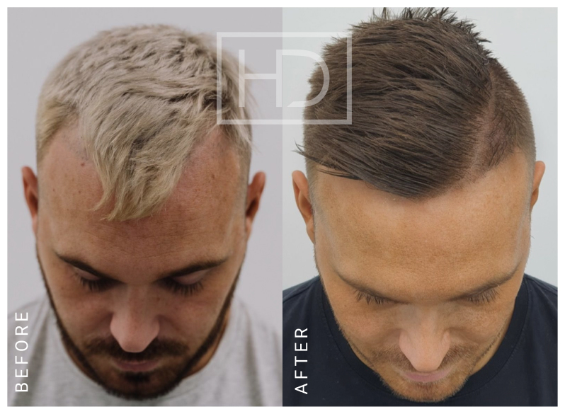 Doctor Hair Transplant Before & After