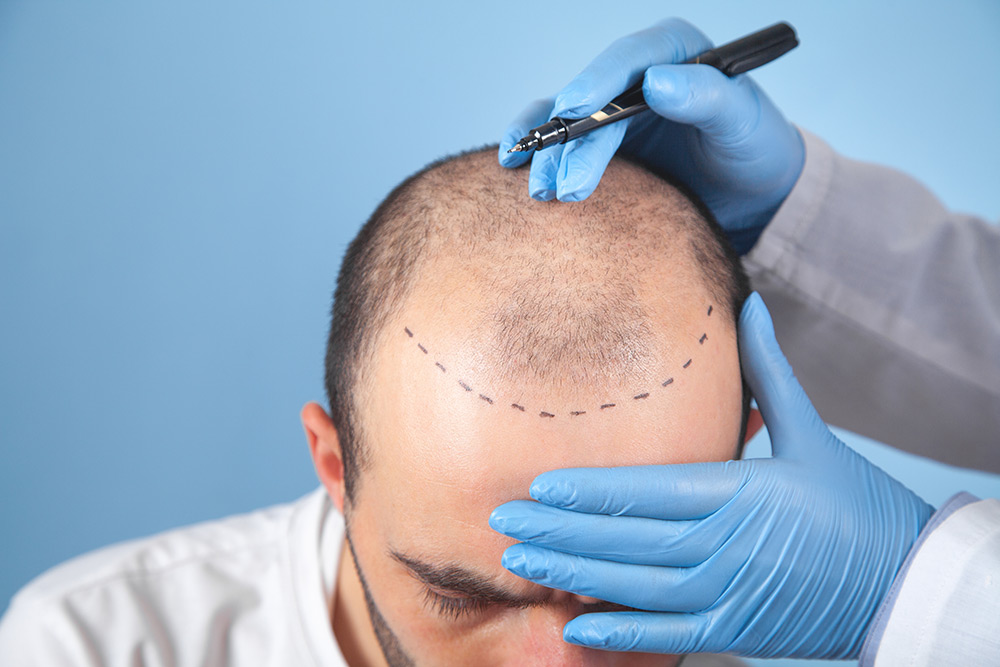 How to Prevent Hair Loss For Men Naturally | Male Pattern Baldness | Stop Losing Hair | Promote New Hair Growth | Hair Doctors Australia