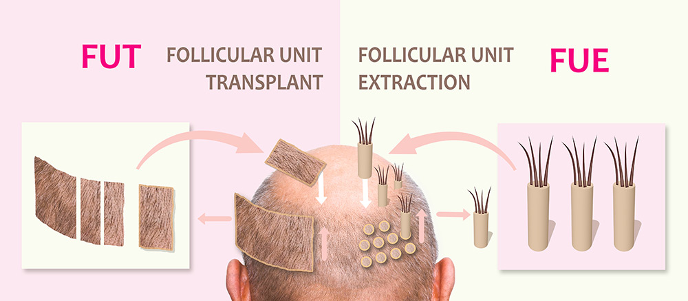 Methods of Hair Transplant Surgery | What is the Most Effective Hair Transplant Method | Best Hair Transplant Method | Hair Transplant Clinic | Hair Doctors Australia
