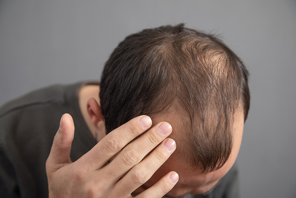 Do Steriods Cause Hair Loss | Hormonal Imbalance Due to Steroid Use | Thinning Hair | Steroid Hair Loss | Hair Doctors Australia