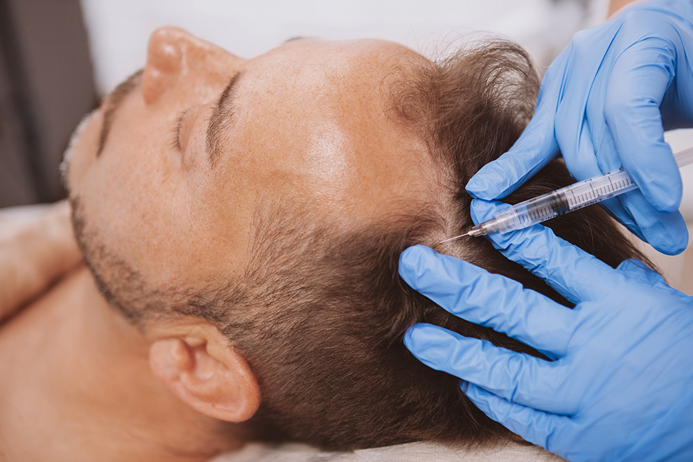 Platelet-rich plasma (PRP) therapy for hair