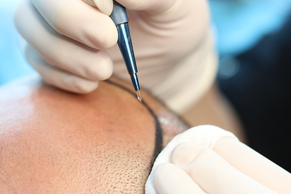 Latest Hair Transplant Technology | Hair Restoration Breakthroughs | Treat Male Pattern Baldness | Hair Growth | Hair Doctors Sydney Melbourne