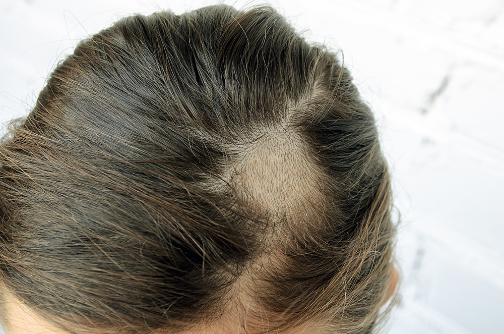 Prevent Scalp Infections | Stop Further Hair Loss & Permanent Bald Spots | Hair Regrowth Treatment | Hair Restoration Clinic | Hair Doctors Australia
