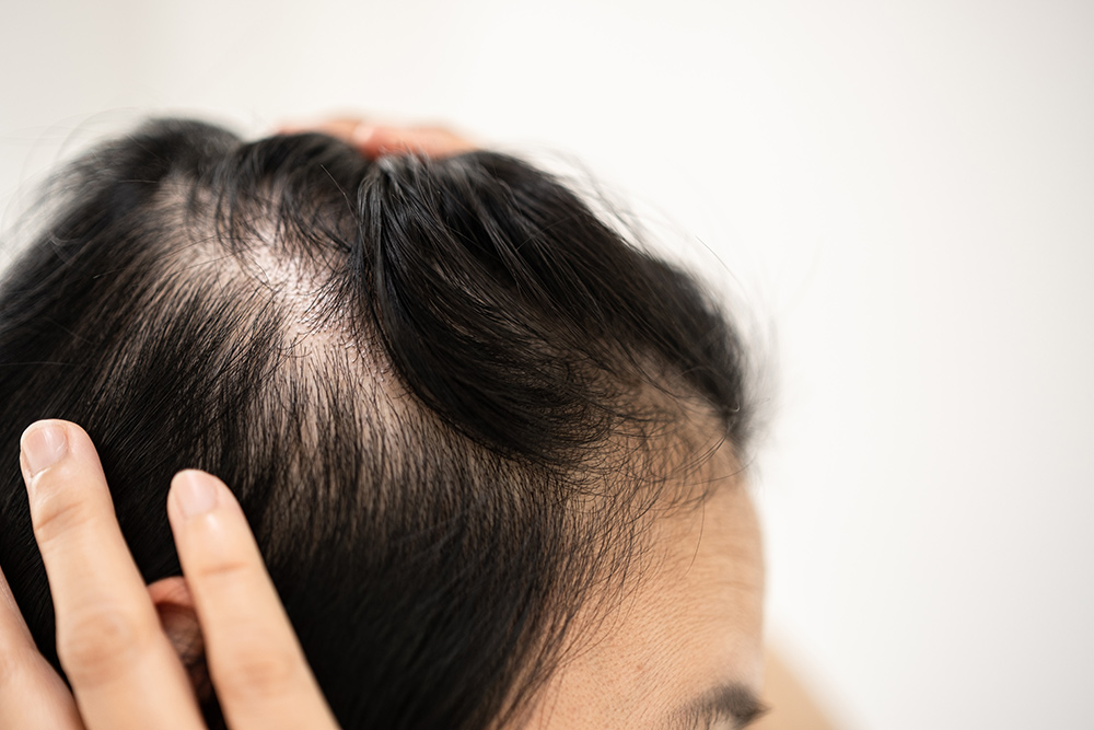 PRF Hair Treatment | Hair Regrowth | Early Treatment When Losing Hair | Regrow Healthy Hair Follicles | Hair Doctors Melbourne & Sydney
