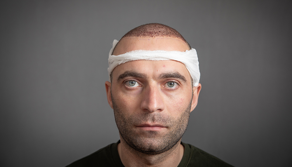 Hair Transplant Recovery Time | Hair Transplant Procedure Recovery Tips | FUE Hair Transplant | Hair Doctors Australia
