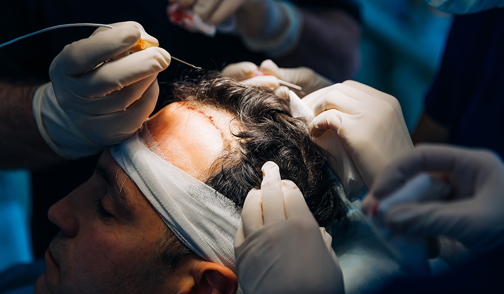 Androgenetic Alopecia | Stages Of Hair Loss | Male & Female Pattern Hair Loss | Hair Growth Cycle | Hair Doctors Sydney & Melbourne