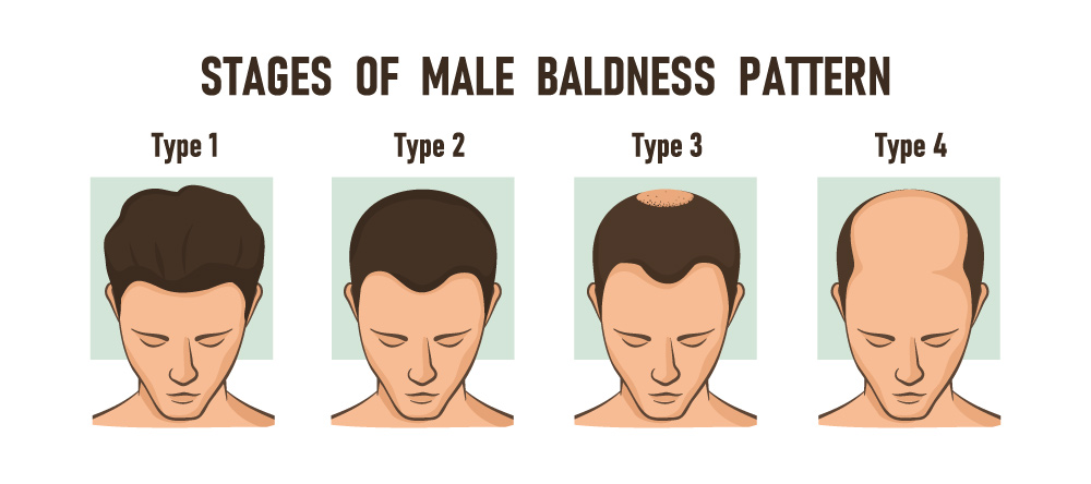 Be Aware Of Early Signs Of Hair Loss | Male & Female Hair Loss | What To Do About Thinning Hair | Doctor-Led Hair Growth Treatments Australia
