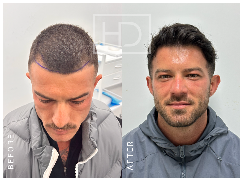 BEAU — 1500 grafts