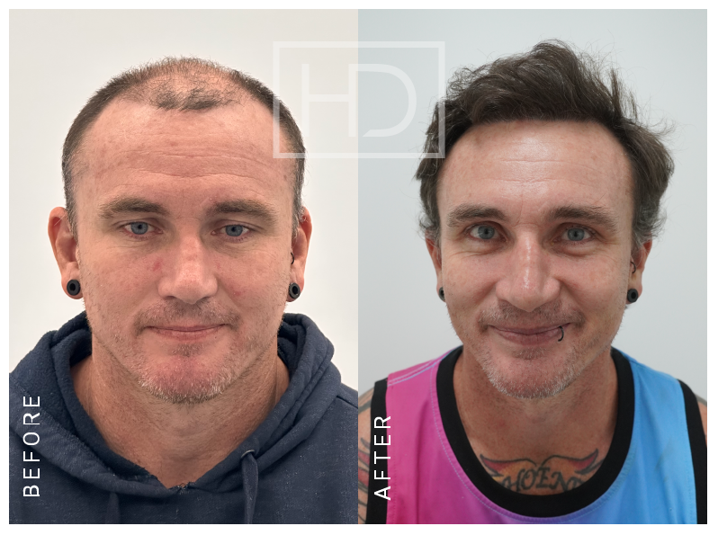 JAMES — 3500 grafts