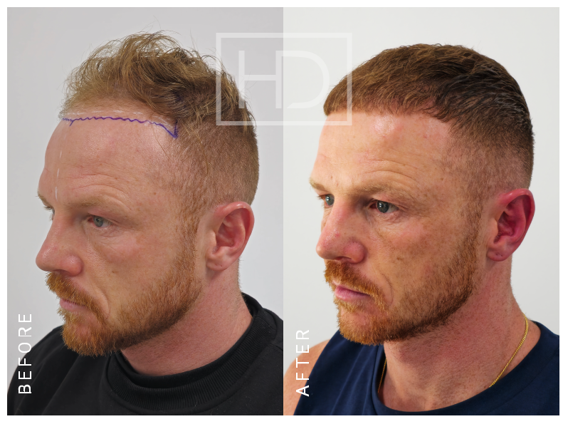 LUKE J — 3000 grafts