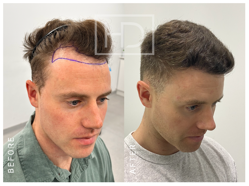 LUKE M — 2000 grafts