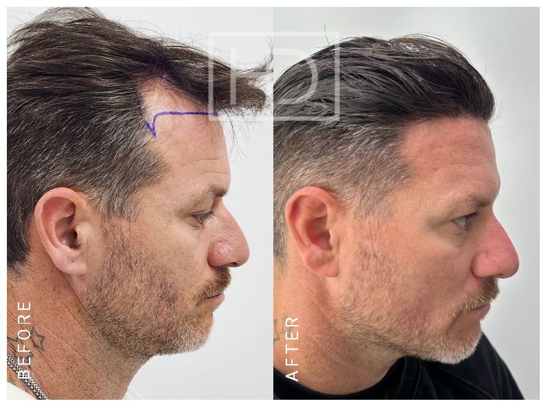 MAURO — 2500 grafts