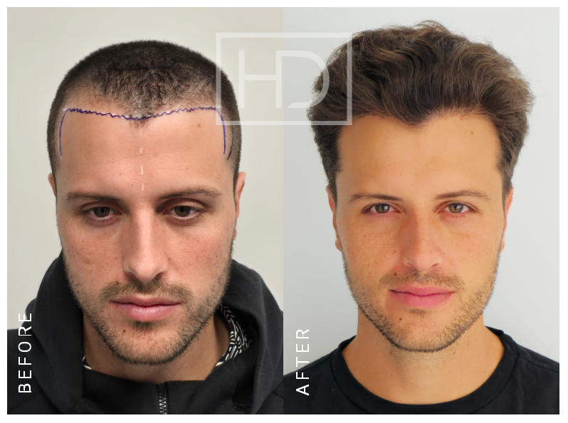 NATHAN — 2500 grafts