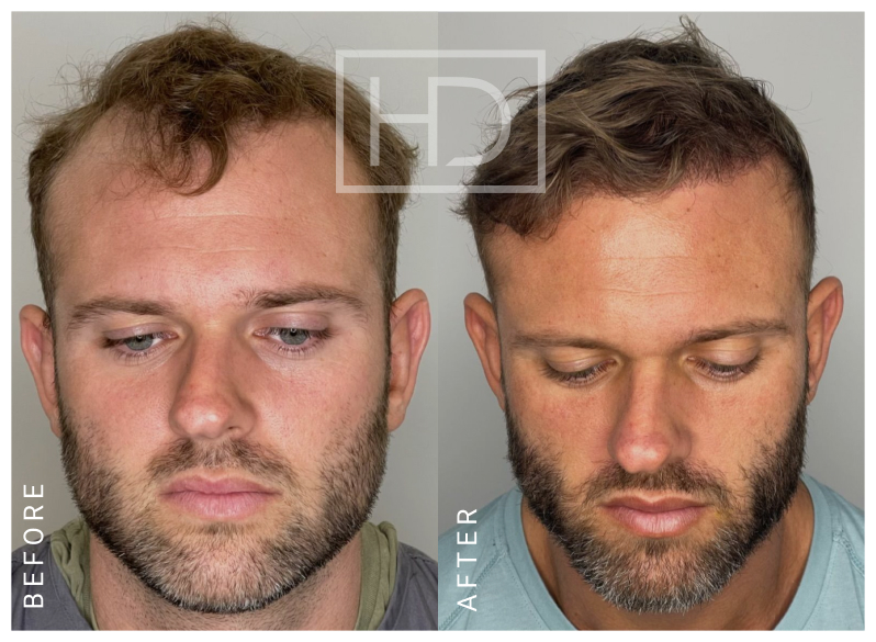 Treatment For An Uneven Hairline | Hair Transplantation For Men & Women | Hair Restoration | Hair Loss Clinic Melbourne, Sydney, Parramatta | Hair Doctors