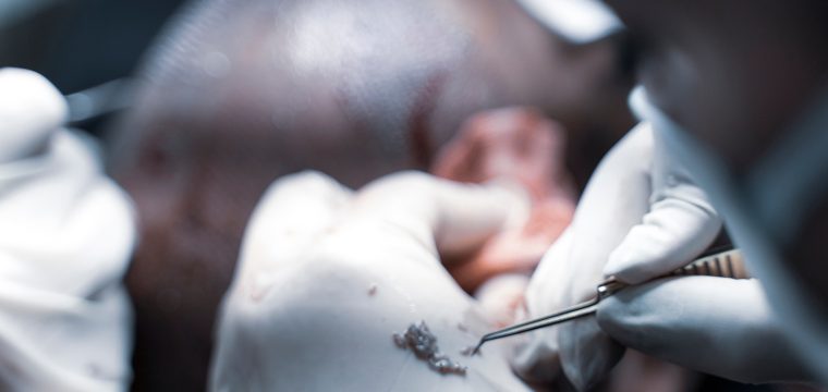 Second Hair Transplant | Hair Restoration | Hair Loss Clinic Melbourne, Sydney, Parramatta | Hair Doctors