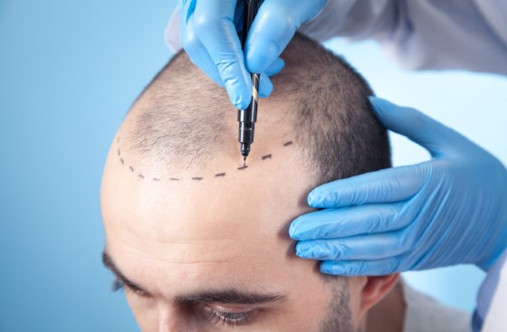 Second Hair Transplant | Hair Restoration | Hair Loss Clinic Melbourne, Sydney, Parramatta | Hair Doctors