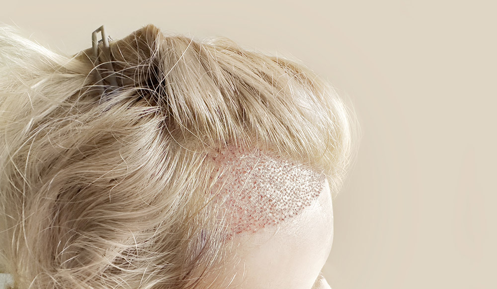 Female Pattern Balding | Thinning Hair | Eyebrow Hair Restoration | Female Hair Restoration | Hair Regrowth | Hair Doctors Sydney, Melbourne